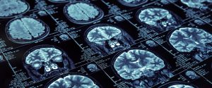 Why the FDA Was Correct in Approving Biogen’s Aducanumab