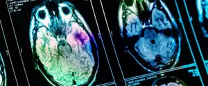 Finding a Neurology Expert Witness